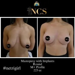 #beforeandafter @netricosmeticsurgery #mrnetri #upliftwithimplants #netrigirl #plasticsurgeon #cheshire