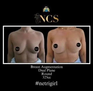 #beforeandafter @netricosmeticsurgery #mrnetri #netrigirl #breastaugmentation #cheshire