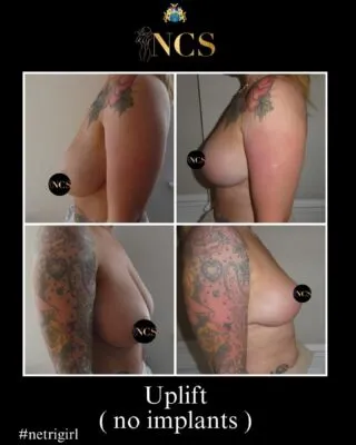 #beforeandafter @netricosmeticsurgery #mrnetri #netrigitrl #uplift #mastopexy #naturallook #plasticsurgeon #cheshire